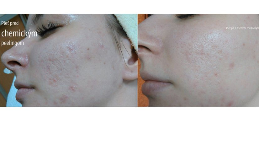 ŠKOLENIE BIOrevitalizujúci AHA PEELING 05.10.2026