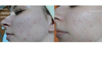 Klientka s aknóznou pleťou absolvovala 7 ošetrení AHA GlycoHYAL peelingu Použité prípravky: AHA G30, AHA G35 Na domácu starostlivosť boli použité prípravky: AHA GlycoHYAL G10 zjemňujúca emulzia, Tonikum anti-akné, Tonikum zmatňujíce. Kontakt: Kozmetický salón Maja, Nám. oslobodenia 13, Senica, tel.: 0908 038 724