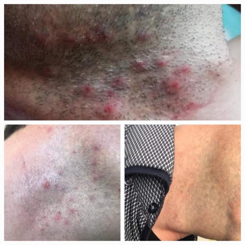 ŠKOLENIE BIOrevitalizujúci AHA PEELING 05.10.2026