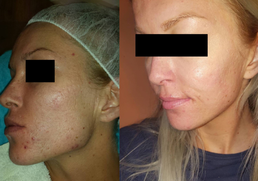 ŠKOLENIE BIOrevitalizujúci AHA PEELING 05.10.2026