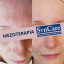 Mezoterapia, Katarína Staňová - Kozmetické štúdio COMFORT, Žilina. Tel.č.: 0903 801 793