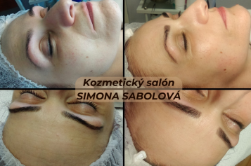 Klientka absolvovala 2 ošetrenia Mezoterapie, Použité prípravky: MezoHYAL 4%, MezoBOTEX Kontakt: kozmetický salón Simona, Toplianská 15/3 Raslavice, e-mail: simona1604@centrum.sk, tel.: 0910 465 374, www.facebook.com/Kozmetický-salón-Simona-221965531148429/