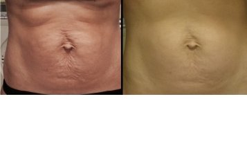 Klientka vo veku 35 rokov, po 3. tehotenstve absolvovala 6 ošetrení dermarollerovej Mezoterapie Použité prípravky: MezoCELLULITE Na domácu starostlivosť boli použité prípravky: StriaHyal gel. Kontakt: Salón SynCare, Istrijská 49, Bratislava - Devínska Nová Ves tel.: 0948 225 020