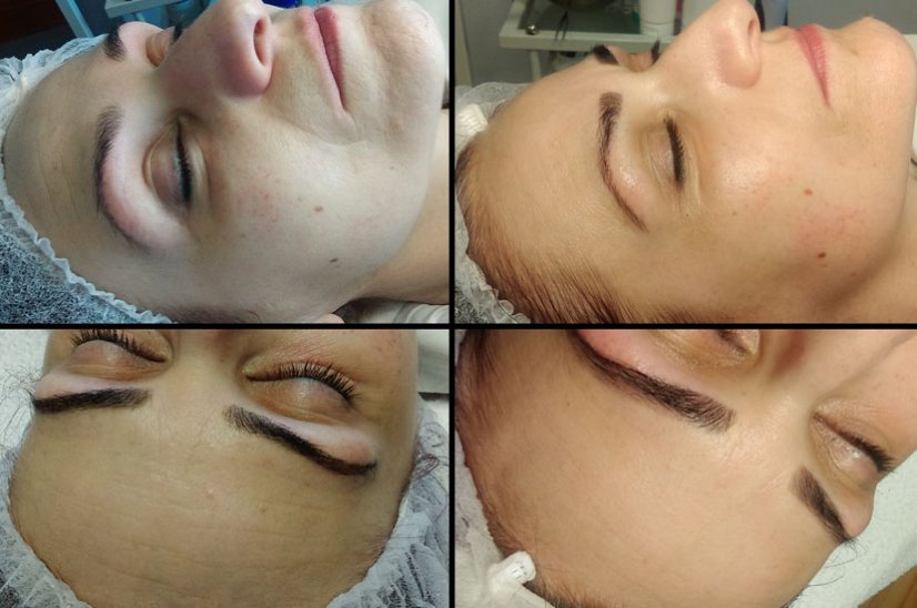 ŠKOLENIE MEZOTERAPIA & MICRONEEDLING 26.10.2026