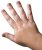 Vitiligo
