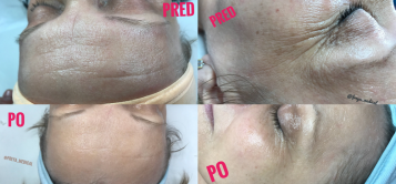Klietka absolvovala kúru DermaBOTEXIN, s ktorou sa podarilo viditeľne zredukovať výraznejšie mimické vrásky. Výsledok sa podarilo dosiahnuť pani kozmetičke Bc. Tatiane Novákovej z Freya esthetic&medical v Bratislave, tel.č. 0949 443 057, web: www.freyamedical.sk  instagam: @freya_medical FB: https://www.facebook.com/freya.novak.1