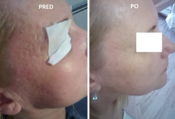Klientka absolvovala ošetrenia s AHA peelingom a následne po úplnom zregenerovaní bolo vykonaných približne 10 ošetrení Mezoterapie s 1,0 mm Dermarollerom. Použité prípravky: AHA GlycoHyal, 4% MezoHYAL sérum. Kontakt: Petra Belková Dubašíková, Čadca, tel.: 0908 567 004