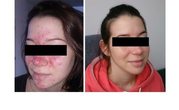 AKNÉ ROSACEA - Klientka vo veku 25 rokov. Domáca starostlivosť: Mlieko anti-akné, Tonikum anti-akné, Gél pri aktívnom akné, Sebunorm krém.  Po 5 mesiacoch: zápal ustúpil a začala používať Biomineral hydratačný krém a Decongenesia sérum. Kontakt: Studio Lavender - Dominika Cibulková, Chorvátsky Grob, tel.č. 0908 112 296, e-mail: info.lavenderstudio@gmail.com