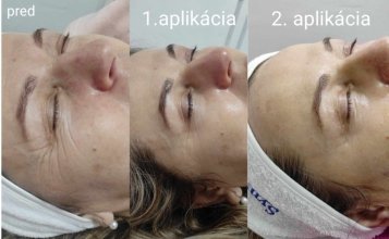 Omladenie pleti prostredníctvom Kolagénových nití. Výsledok sa podarilo dosiahnuť pani kozmetičke Viere Ondrejkovej, Ružomberok